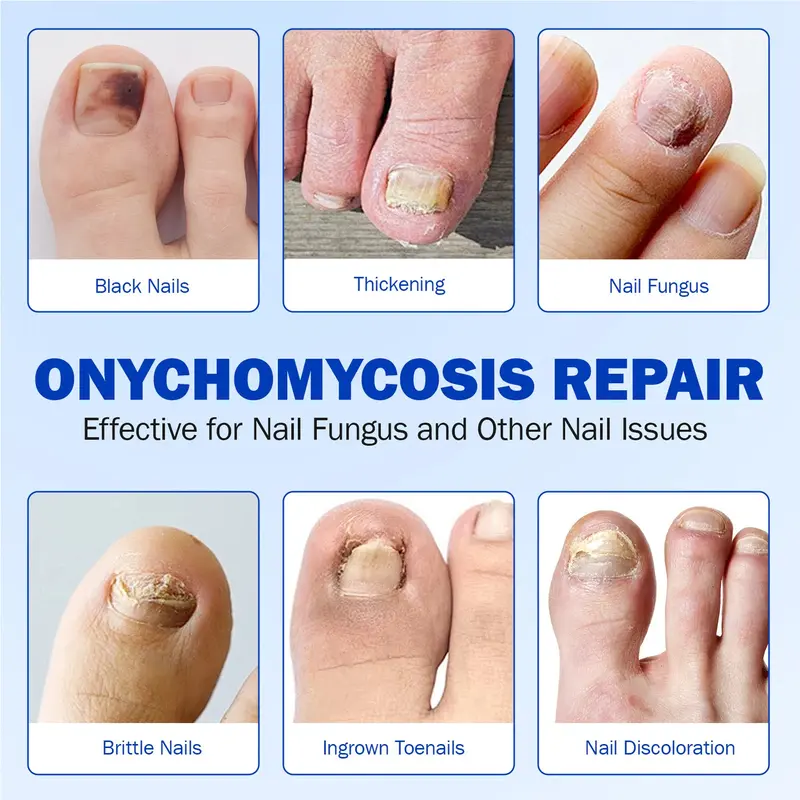 Product Introduction of 21pcs/box Fungal Nail Patches, Nail Health Care Patches, Nail Fungus Care Patches, Suitable for Solving Fungal Nails and Other Nail Problems, Nail Supplies, Daily Care Nails Kit Set 7