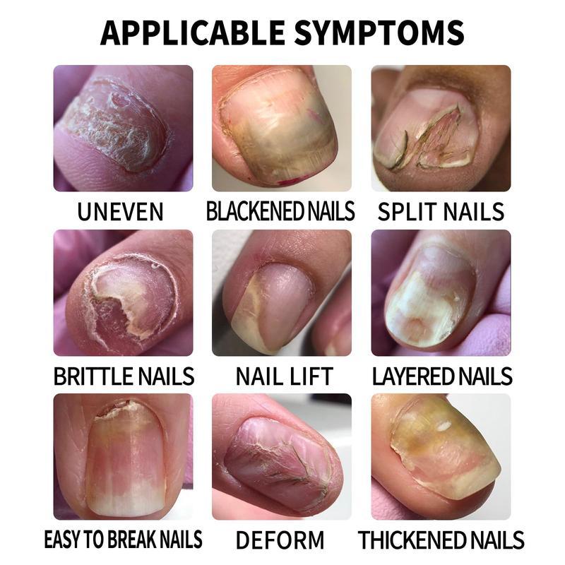 Transform your nail care routine with our 1Oml Nail CareSolution and