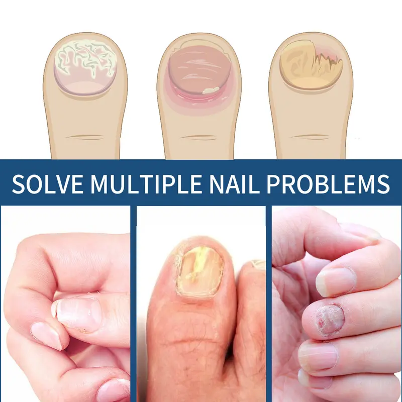 Product Introduction of 21pcs/box Fungal Nail Patches, Nail Health Care Patches, Nail Fungus Care Patches, Suitable for Solving Fungal Nails and Other Nail Problems, Nail Supplies, Daily Care Nails Kit Set 16