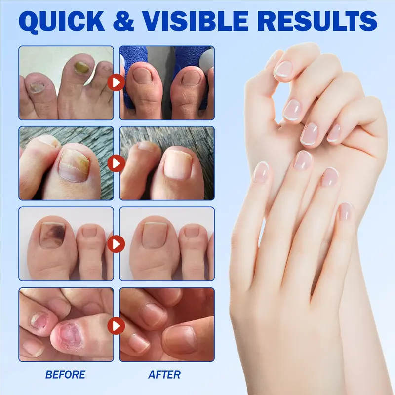 Product Introduction of 21pcs/box Fungal Nail Patches, Nail Health Care Patches, Nail Fungus Care Patches, Suitable for Solving Fungal Nails and Other Nail Problems, Nail Supplies, Daily Care Nails Kit Set 11